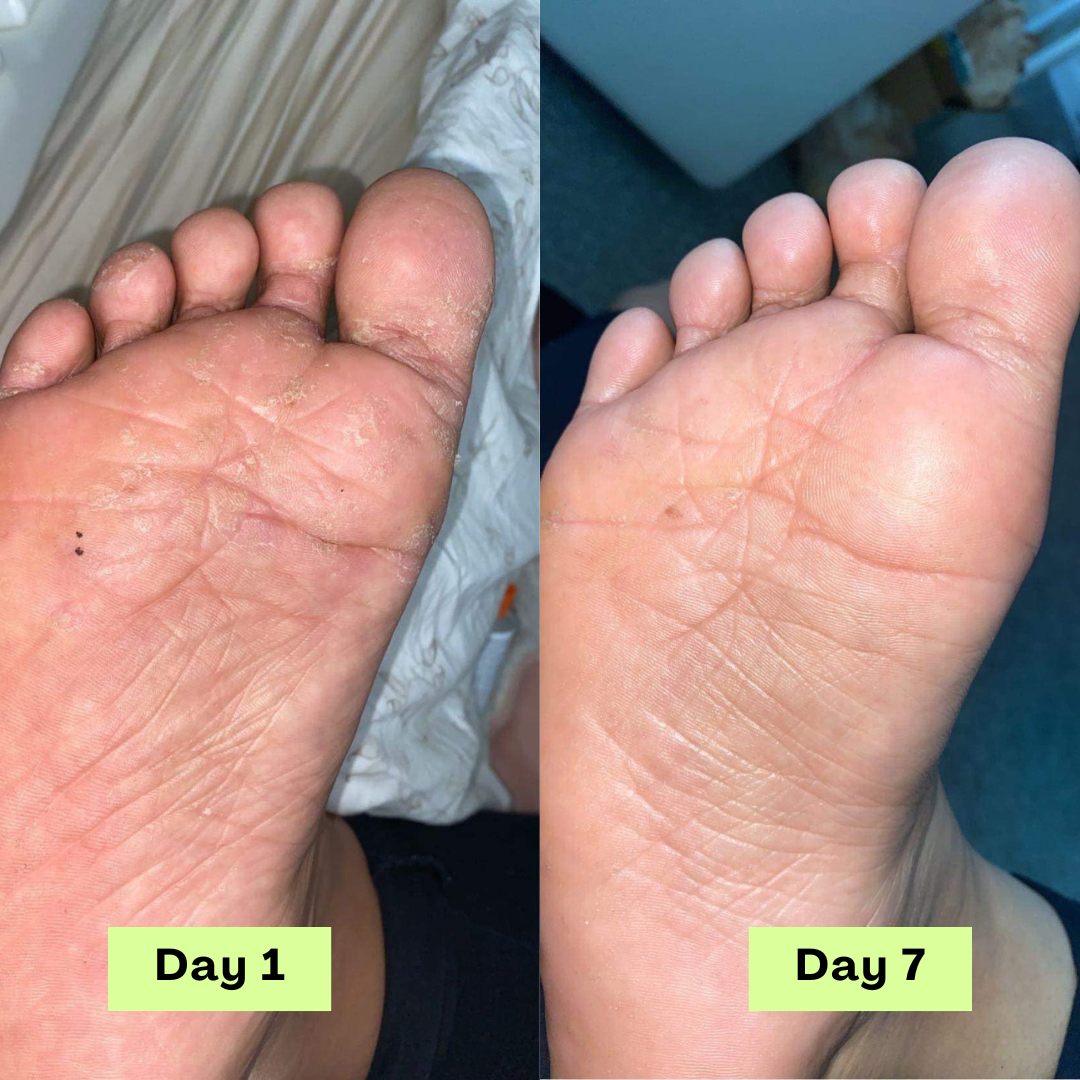 Zénitth AntiFungal Relief Soap Bar